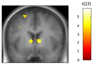 Figure showing the bilateral hyper activation in the level of the ventral striatum when the participants answer correctly to the question in a gamified environment in relation to someone who studies in a different environment (Howard-Jones et al, 2016).
